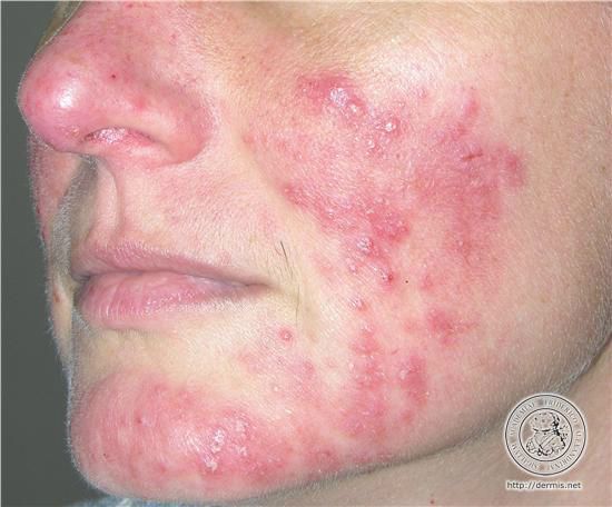 Perioral Dermatitis On Face