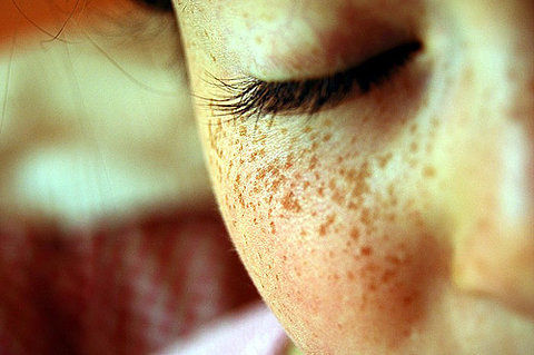 Des taches inflammatoires de pigment