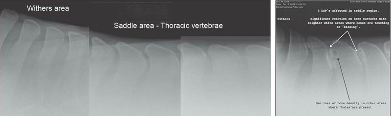 Normal-Xray-vs-Kissing-Spine-Xray